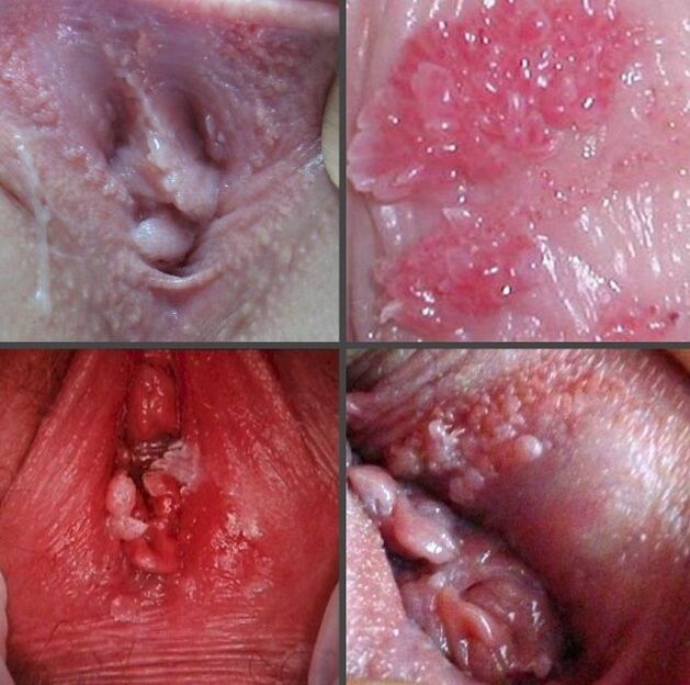 Dúnadh papillomas sa vagina