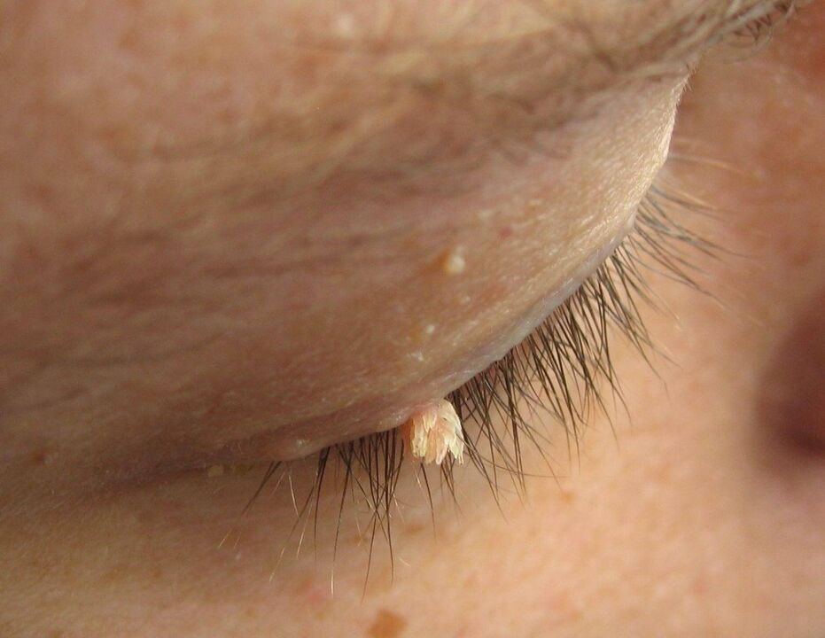 papillomas ar an eyelid