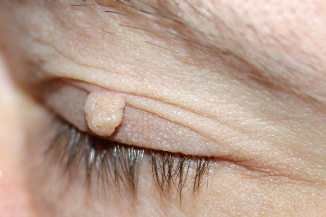 comharthaí papilloma ar an eyelid